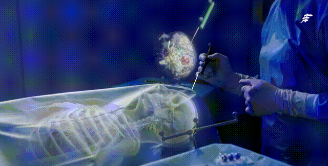 AR技术结合超声引导